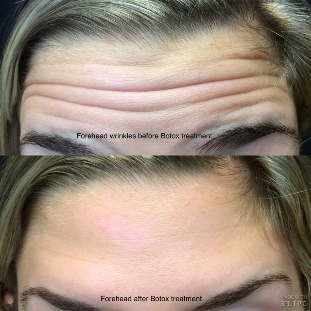 Botox results for forehead wrinkle reduction – natural look, NYC medical spa
