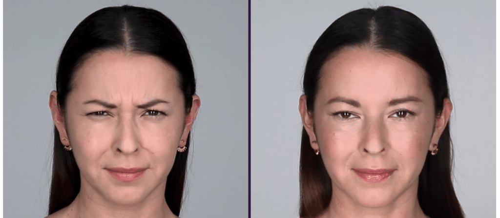Natural results after Botox for frown lines – Dr. Slava Fuzayloff, Manhattan