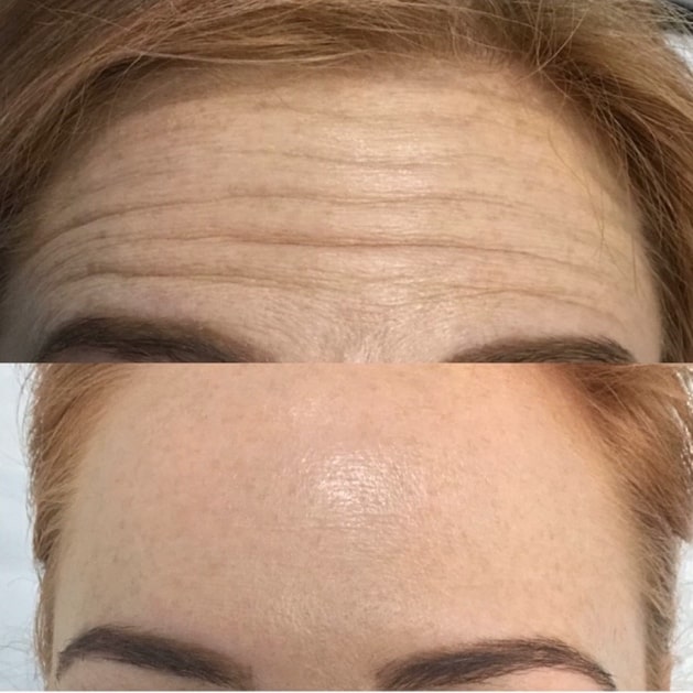 Before and after Botox for forehead lines – Midtown Med Spa NYC, Dr. Slava Fuzayloff