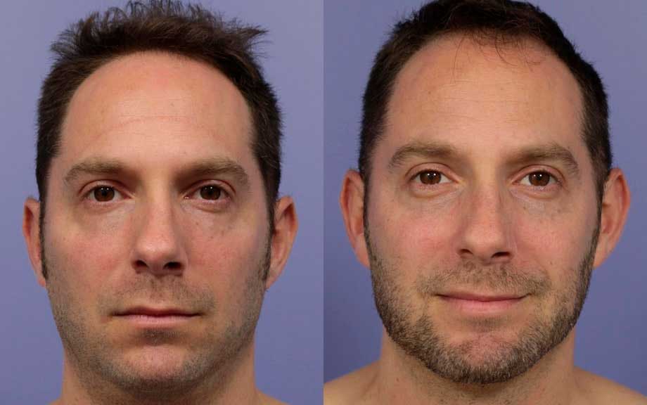 Cheek contour restoration with dermal filler – Dr. Fuzayloff, NYC