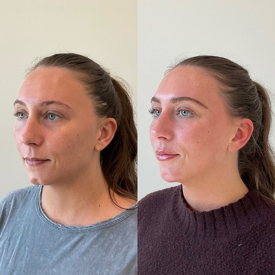 Before and after chin filler augmentation – Midtown Med Spa NYC